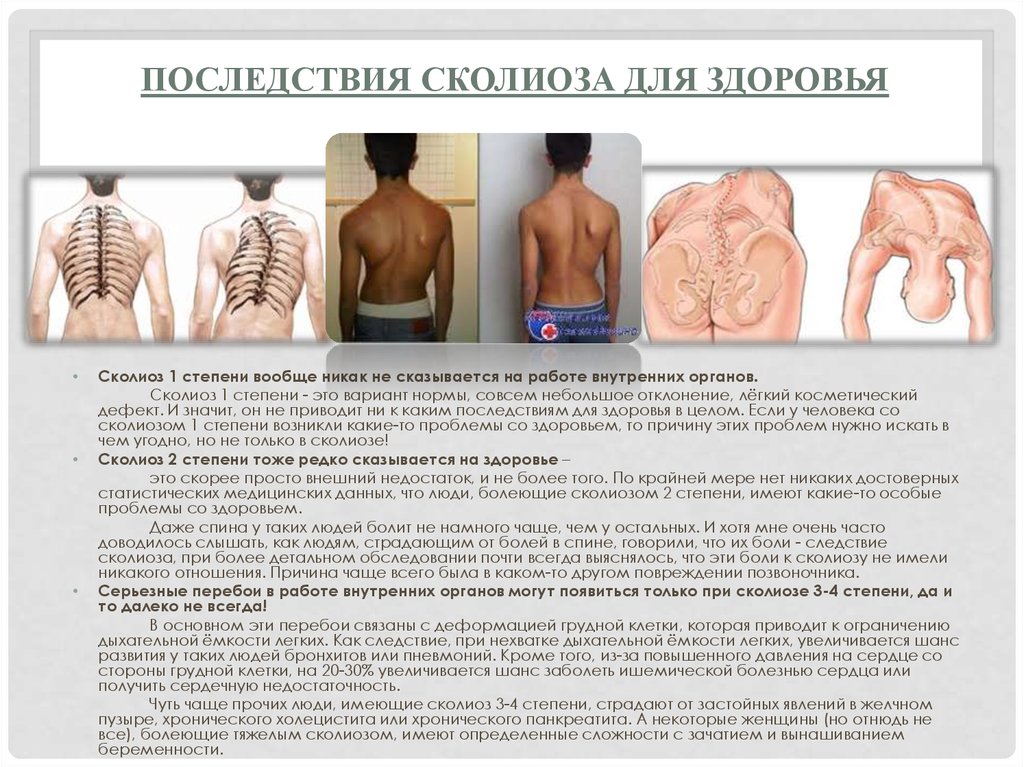Последствия сколиоза для здоровья