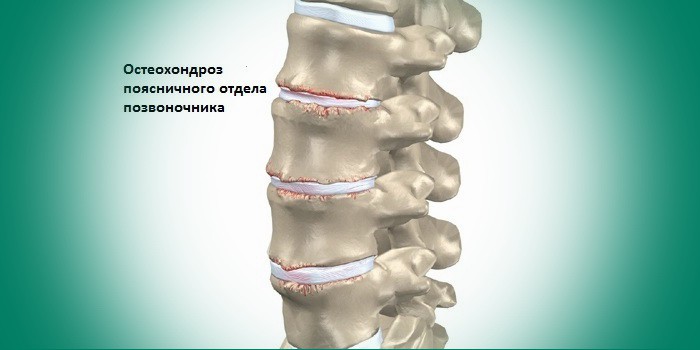 Поясничный остеохондроз