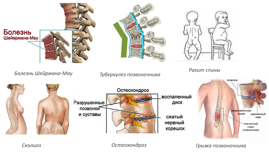 Самые распространенные причины развития кифоза