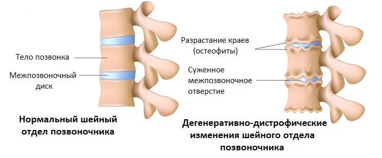 Природа дегенеративно-дистрофических изменений шейного отдела позвоночника