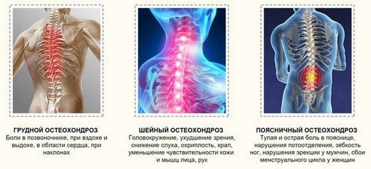 Признаки остеохондроза