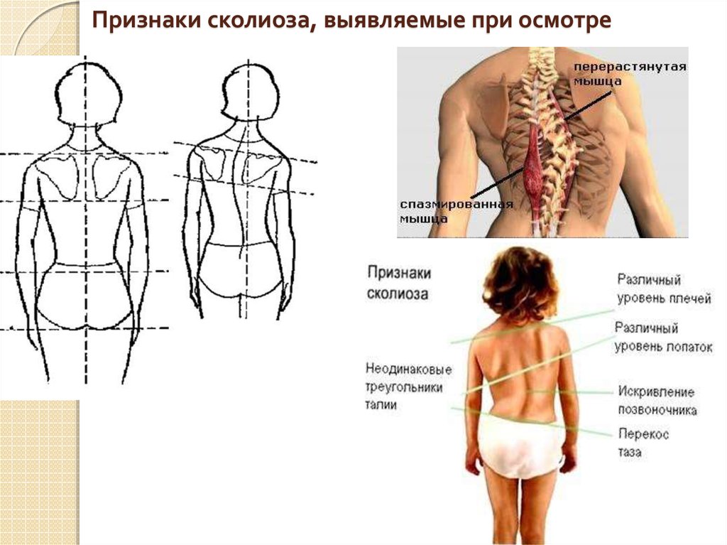 Признаки сколиоза