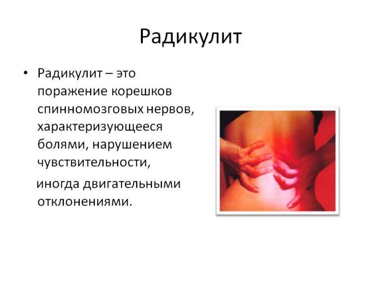 Радикулит