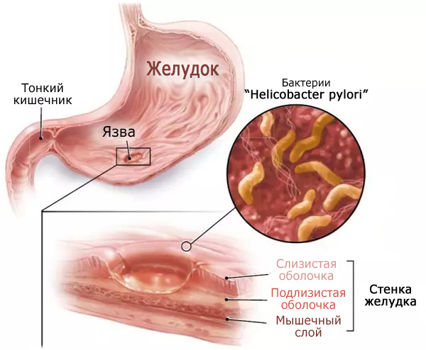 Развитие язвы желудка