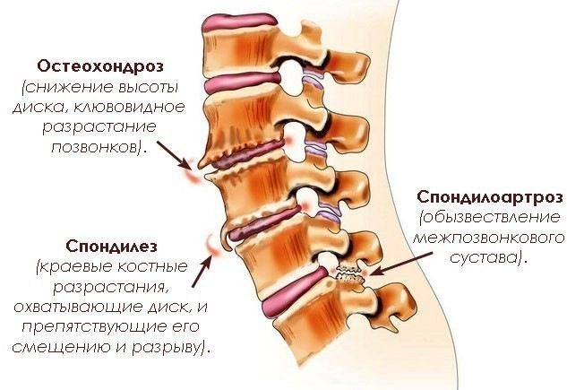 Схематичное изображение спондилеза