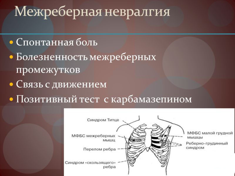 Симптомы межреберной невралгии