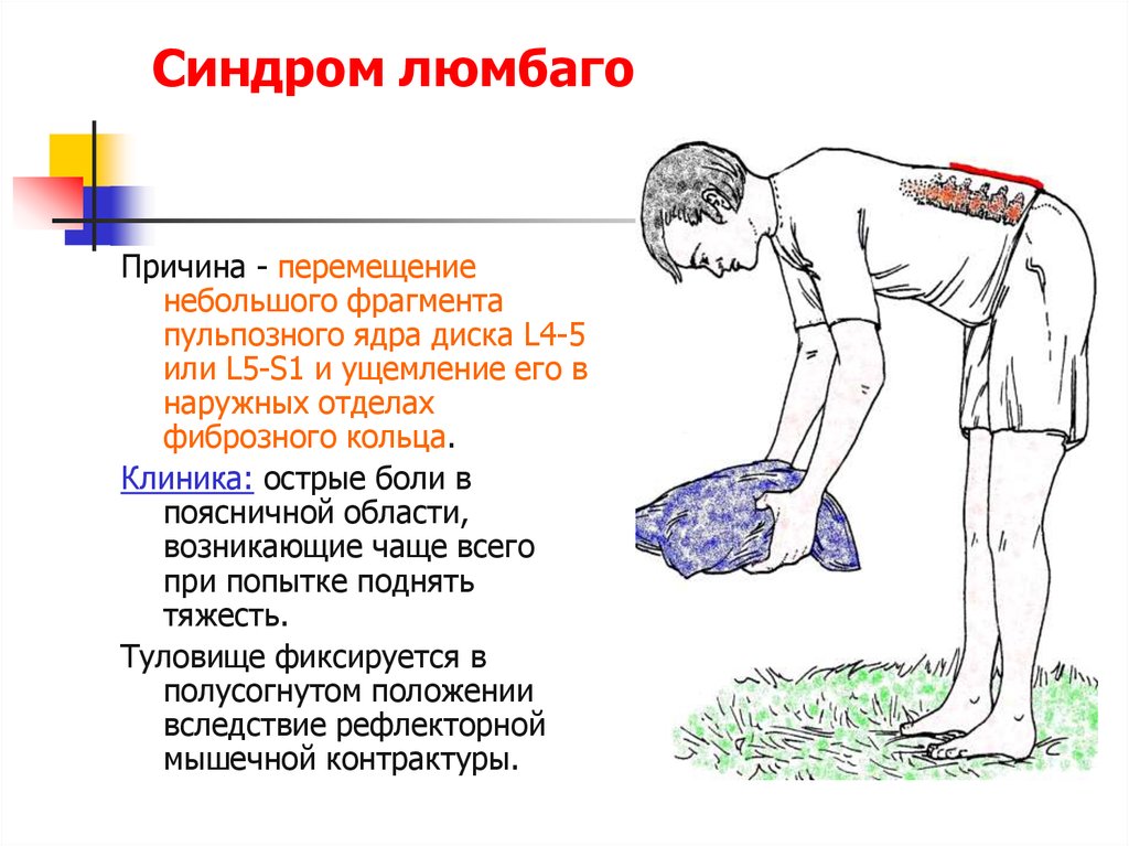 Синдром люмбаго