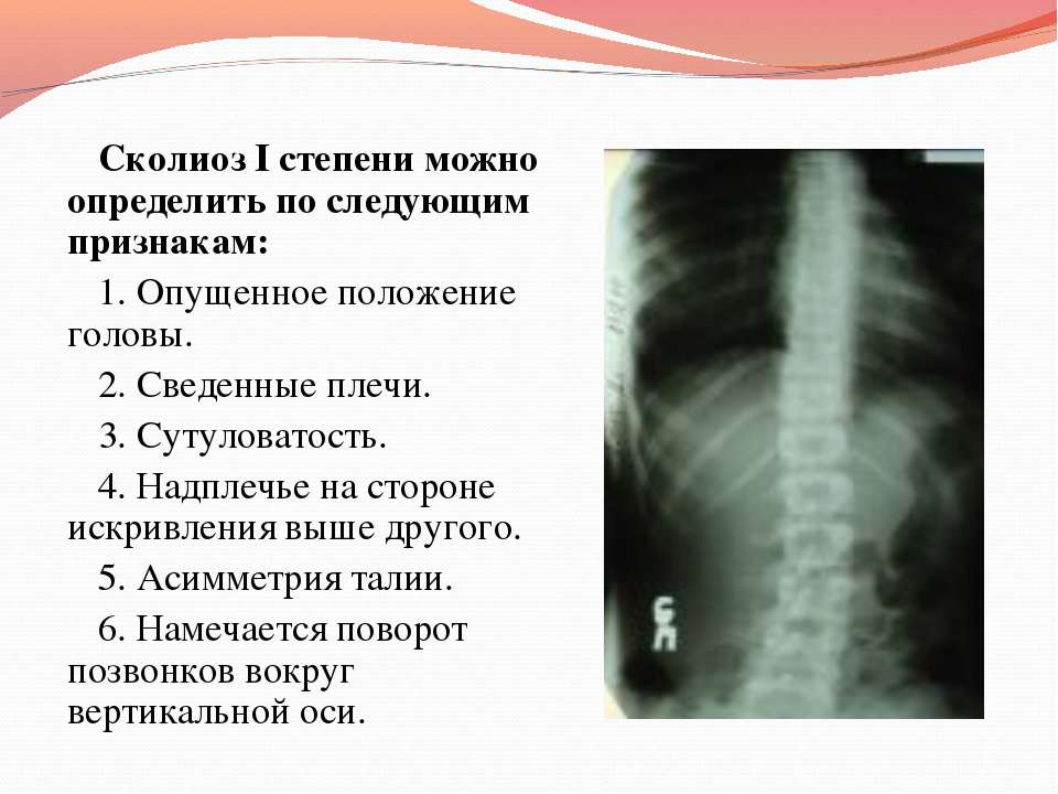 Сколиоз 1 степени