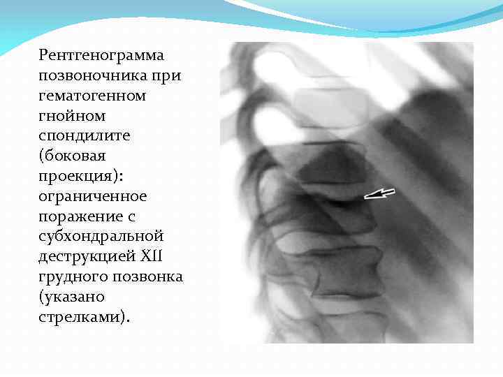 Спондилит позвоночника