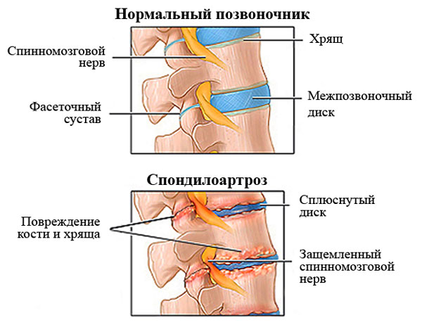 Спондилоартроз