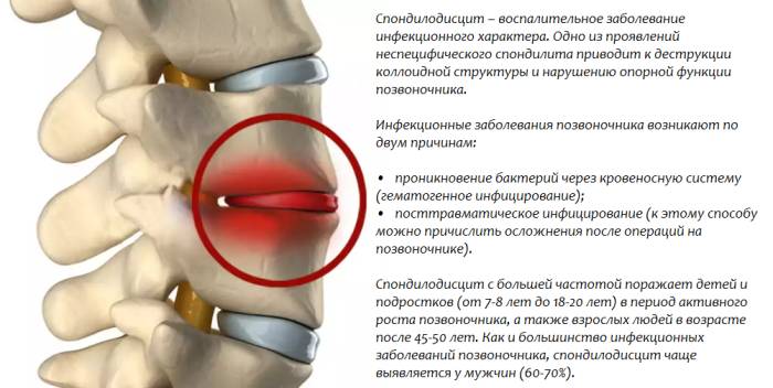 Спондилодисцит позвоночника