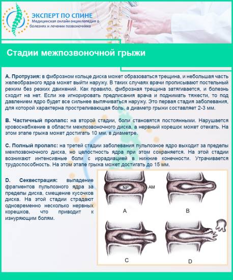 Стадии межпозвоночной грыжи