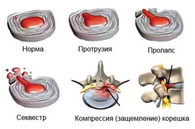 Стадии межпозвоночной грыжи
