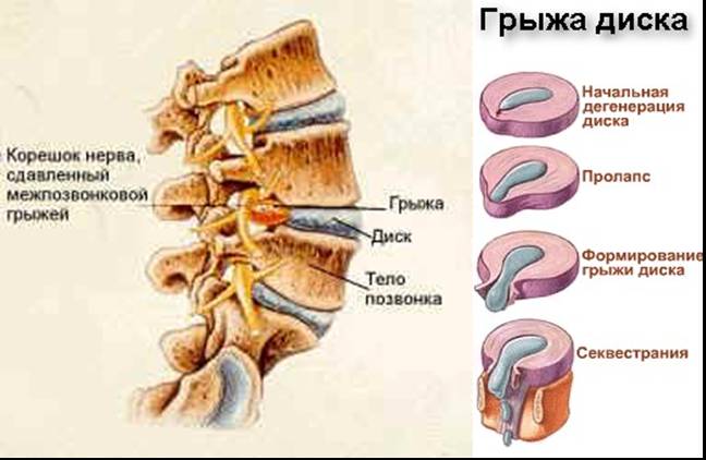 Стадии образования грыжи диска