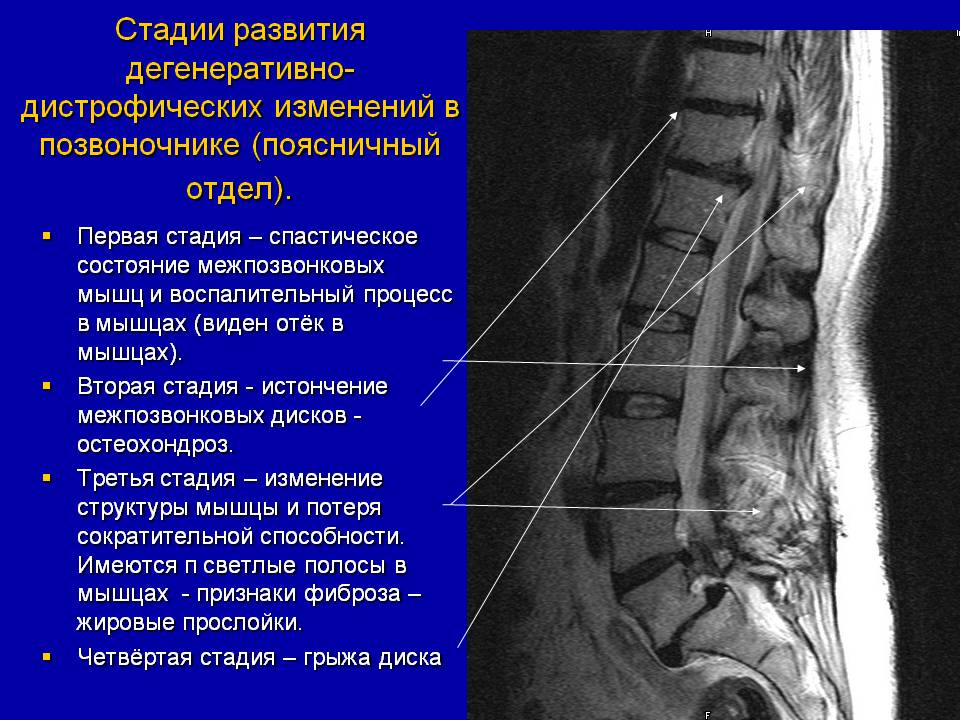 Стадии развития дегенеративно-дистрофических изменений 
