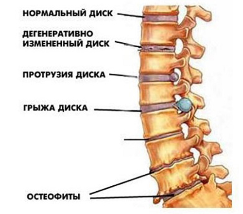 Стадии развития грыжи позвоночника