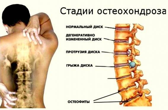 Стадии развития остеохондроза