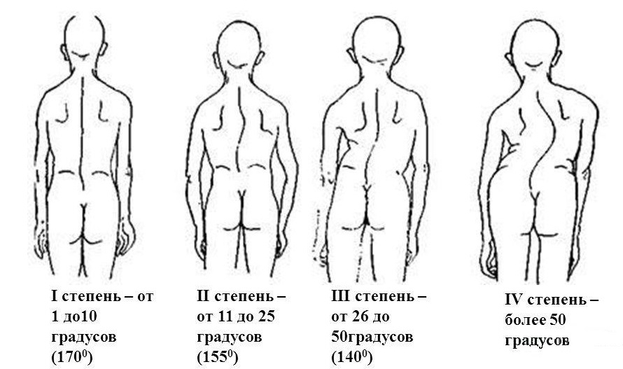 Степени сколиоза