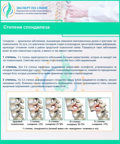 Степени спондилеза