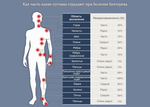 Суставы, наиболее часто страдающие при болезни Бехтерева