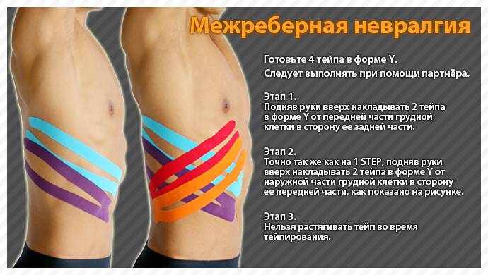Тейпирование при межреберной невралгии