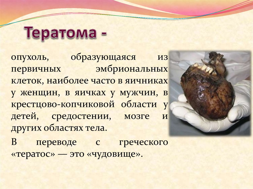 Тератома