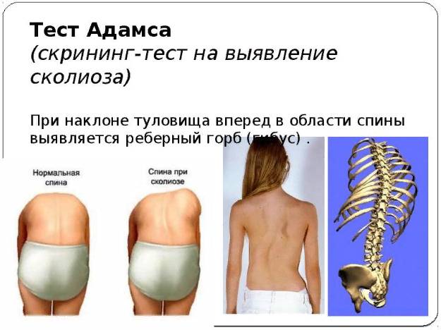 Тест Адамса
