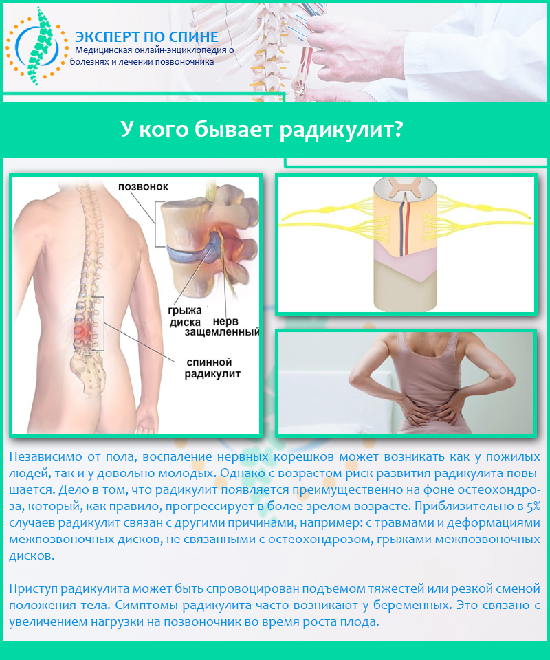 У кого бывает радикулит