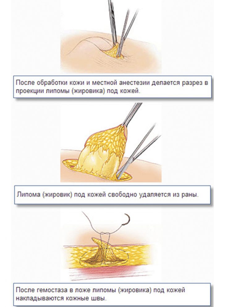 Удаление липомы