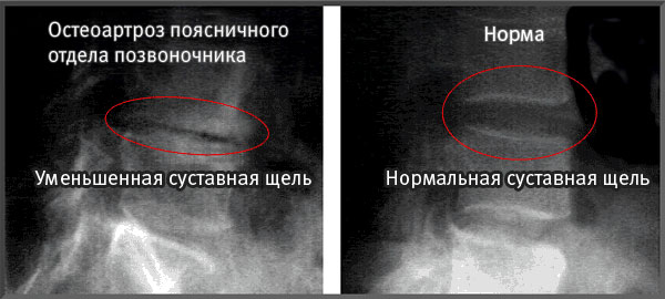 Уменьшение суставной щели при остеоартрозе позвоночника