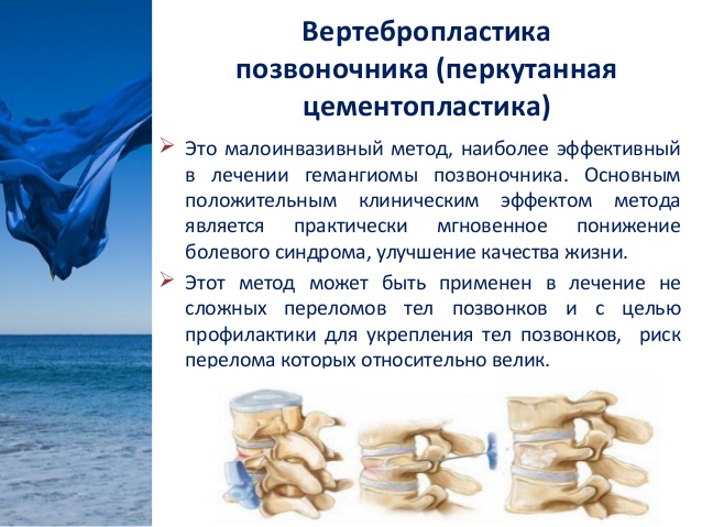 Вертебропластика позвоночника