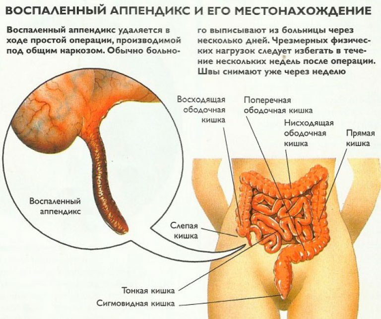 Воспалении аппендикса