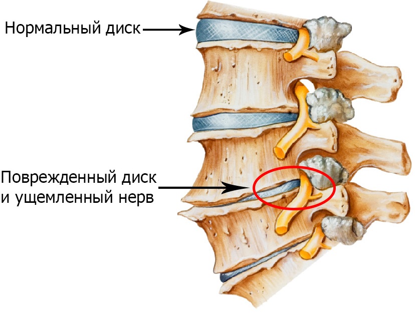 Защемление нерва поврежденным диском