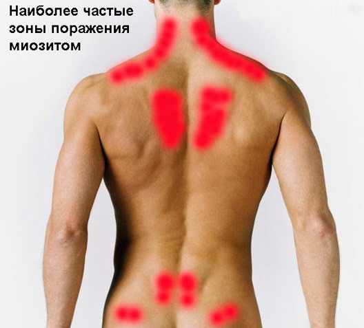 Зоны, которые миозит поражает чаще всего