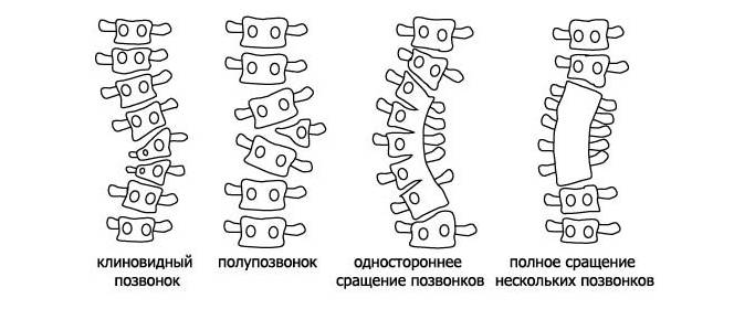 Причиной заболевания могут выступать аномалии развития позвонков