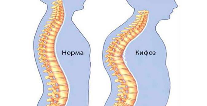 Основной причиной формирования горба является патологический кифоз