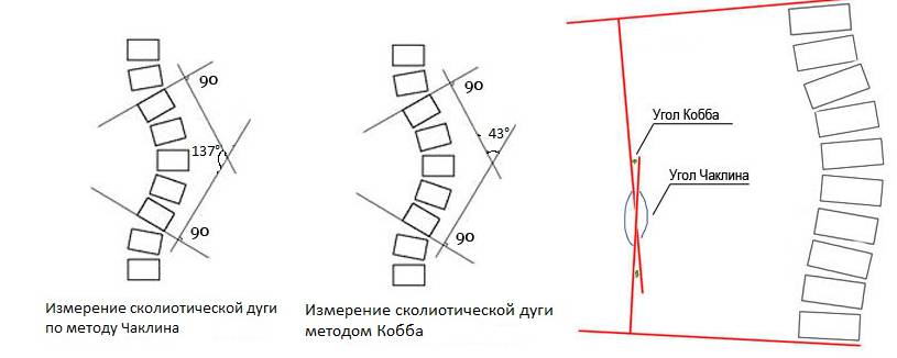 Методики измерения угла искривления позвоночника при сколиозе
