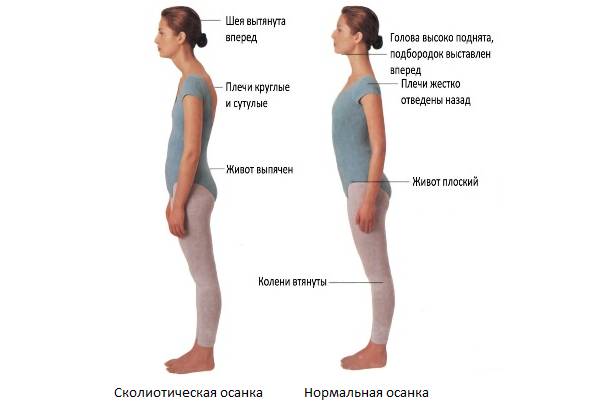 Определить сколиотическую осанку можно по выраженной сутулости плеч, вытянутой вперед шее и выпяченному животу