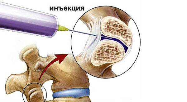 Блокада межпозвоночной грыжи