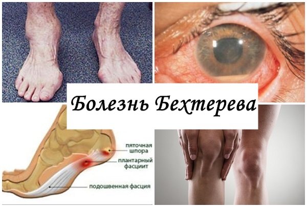 Болезнь Бехтерева