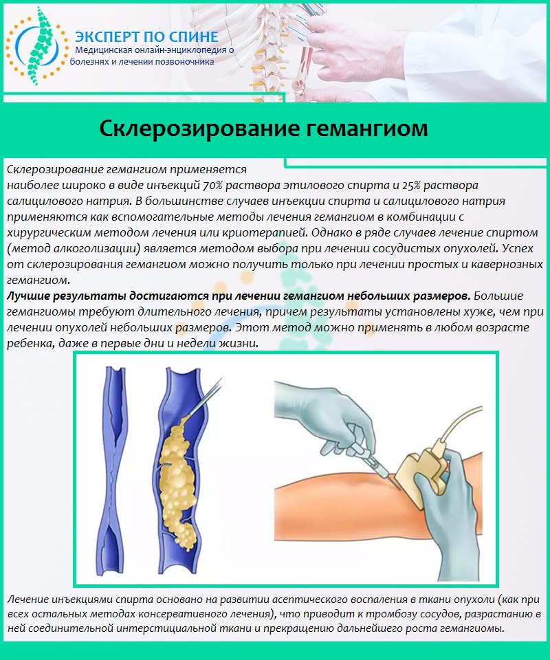 Склерозирование гемангиом