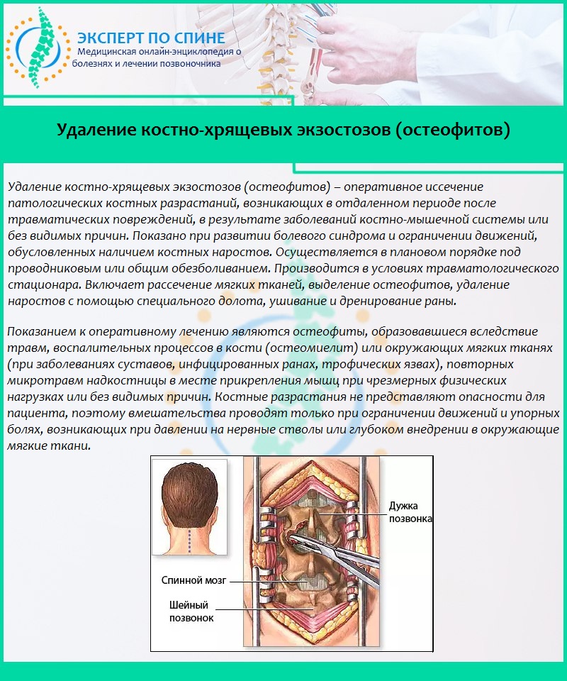 Удаление костно-хрящевых экзостозов (остеофитов)