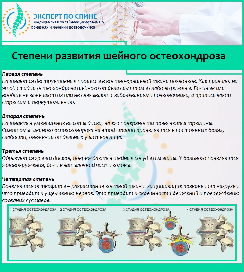 Степени развития шейного остеохондроза