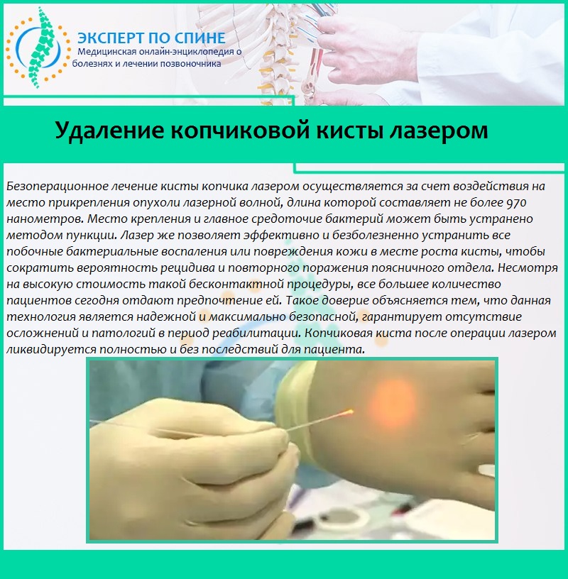 Удаление копчиковой кисты лазером