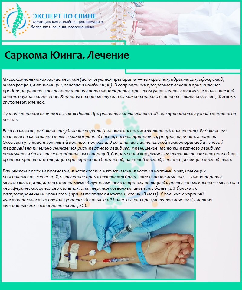 Саркома Юинга. Лечение