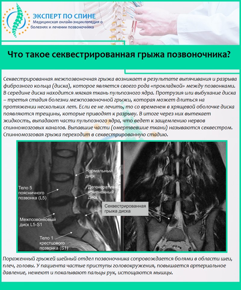 Что такое секвестрированная грыжа позвоночника?