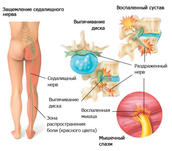 Боли в пояснице, отдающие в ногу
