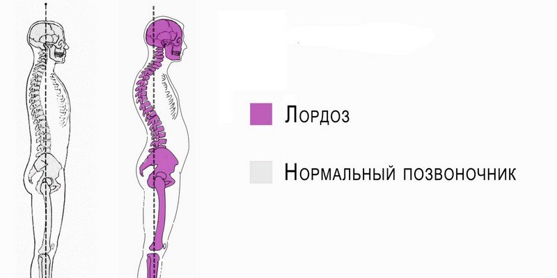 Что такое лордоз