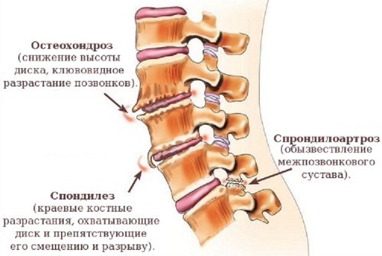 Что такое остеохондроз