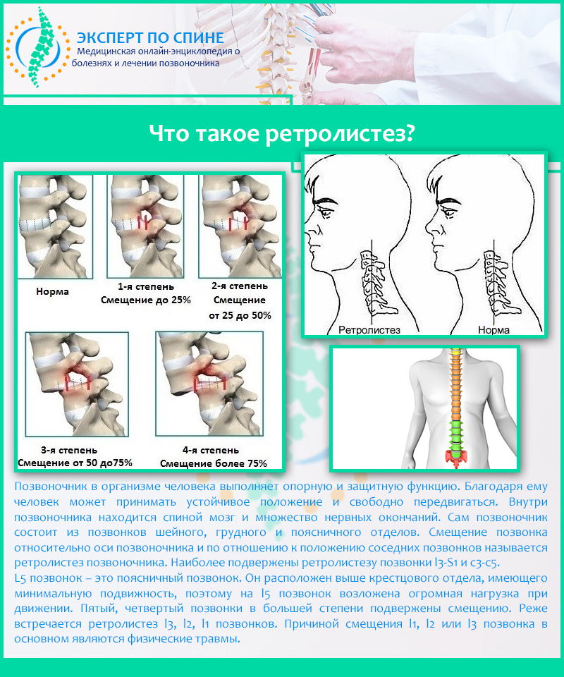 Что такое ретролистез